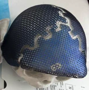Cráneo completo en tres piezas de titanio impreso en 3D para un niño con hidrocefalia.